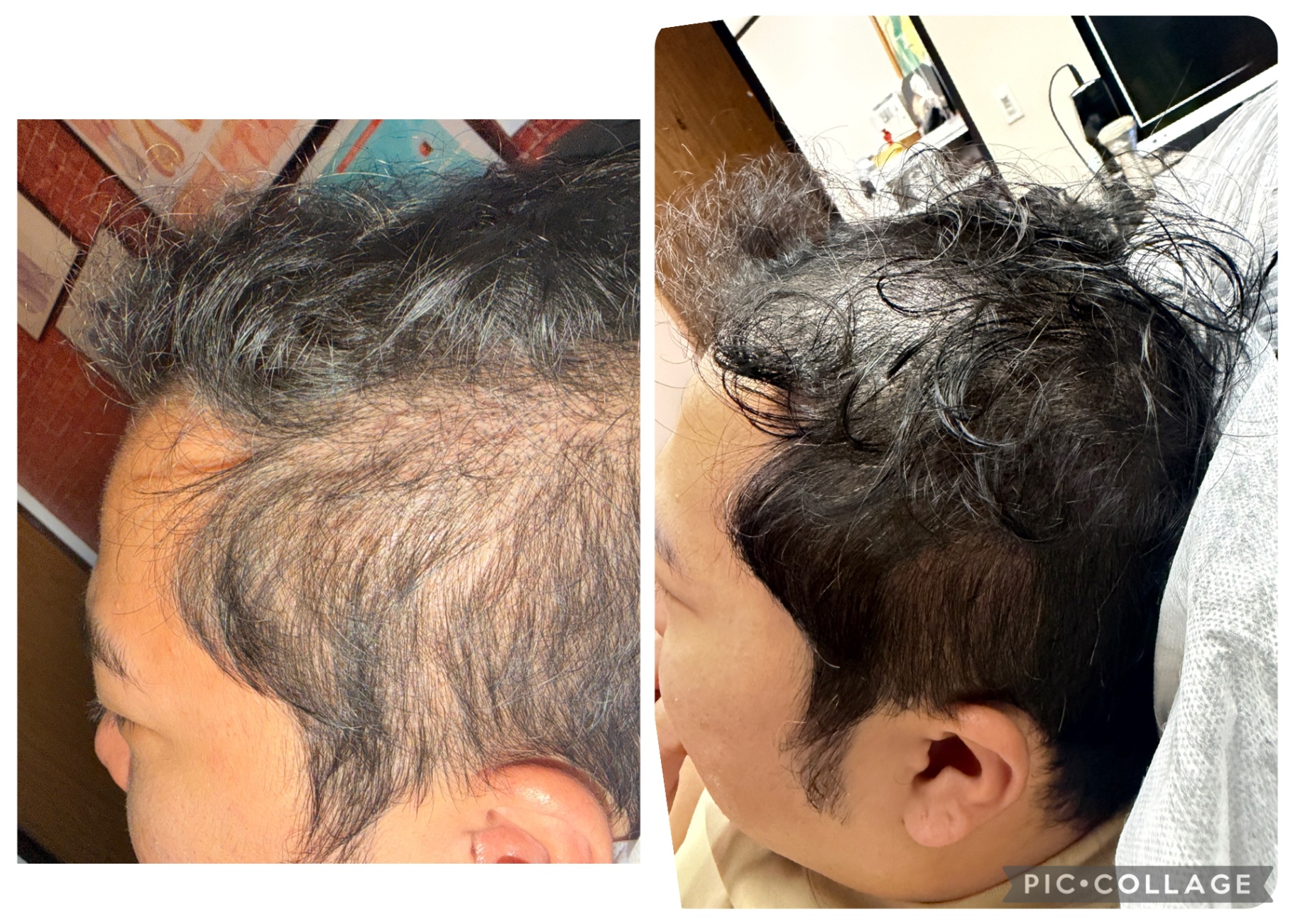 CASE 008 before and after — Men, Hairline, Diffuse Thinning