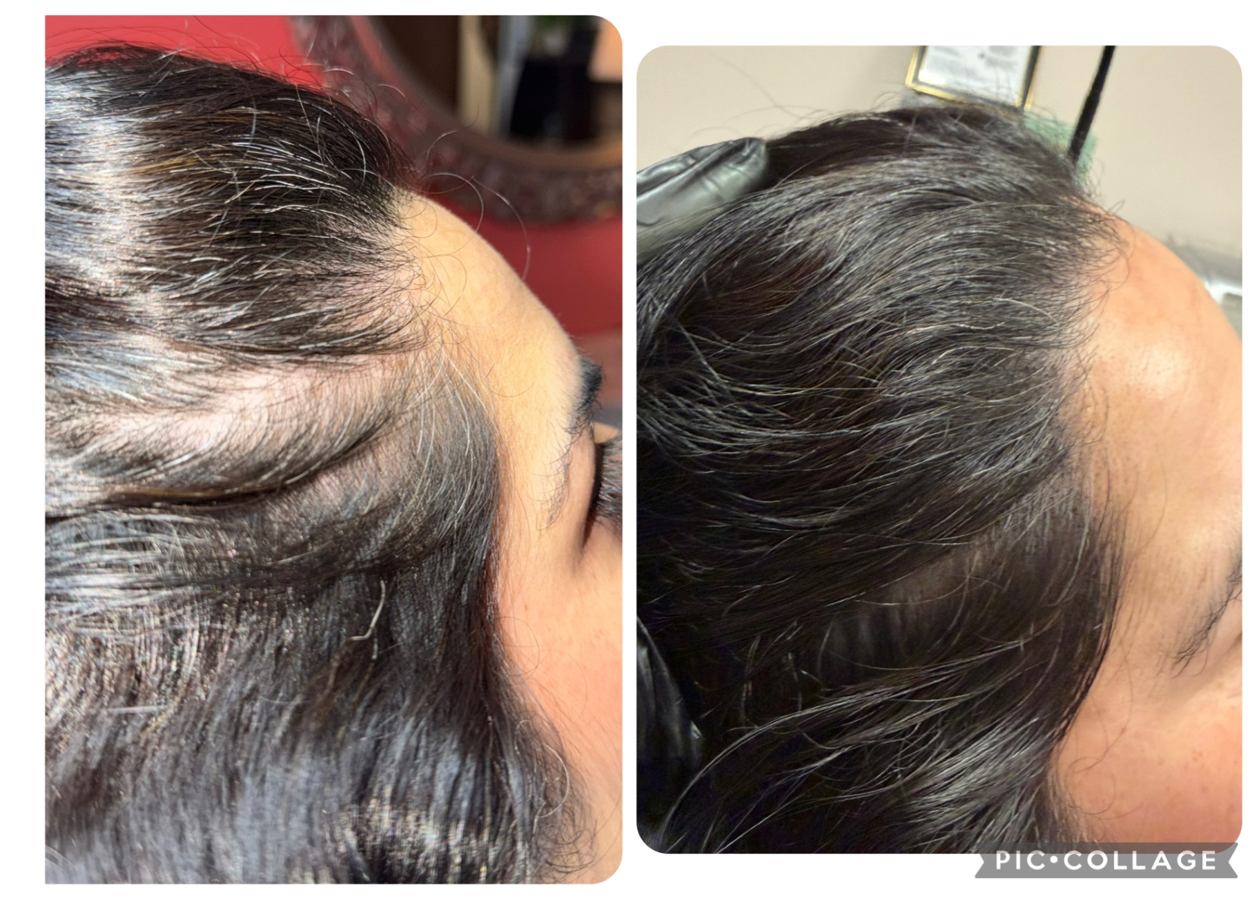 CASE 005 before and after — Women, Hairline, Diffuse Thinning