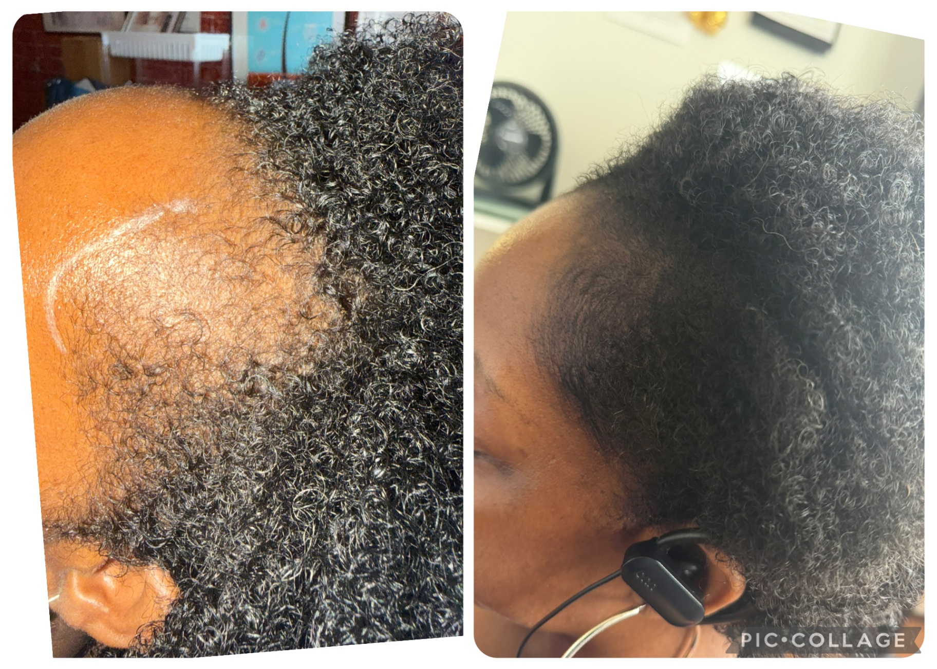 CASE 001 before and after — Women, Hairline, Multicultural Results, Density
