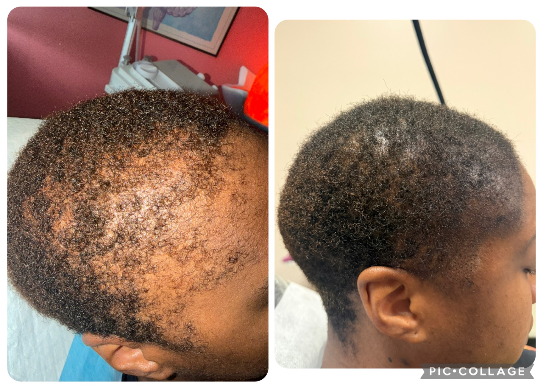 CASE 007 before and after — Men, Hairline, Multicultural Results, Density