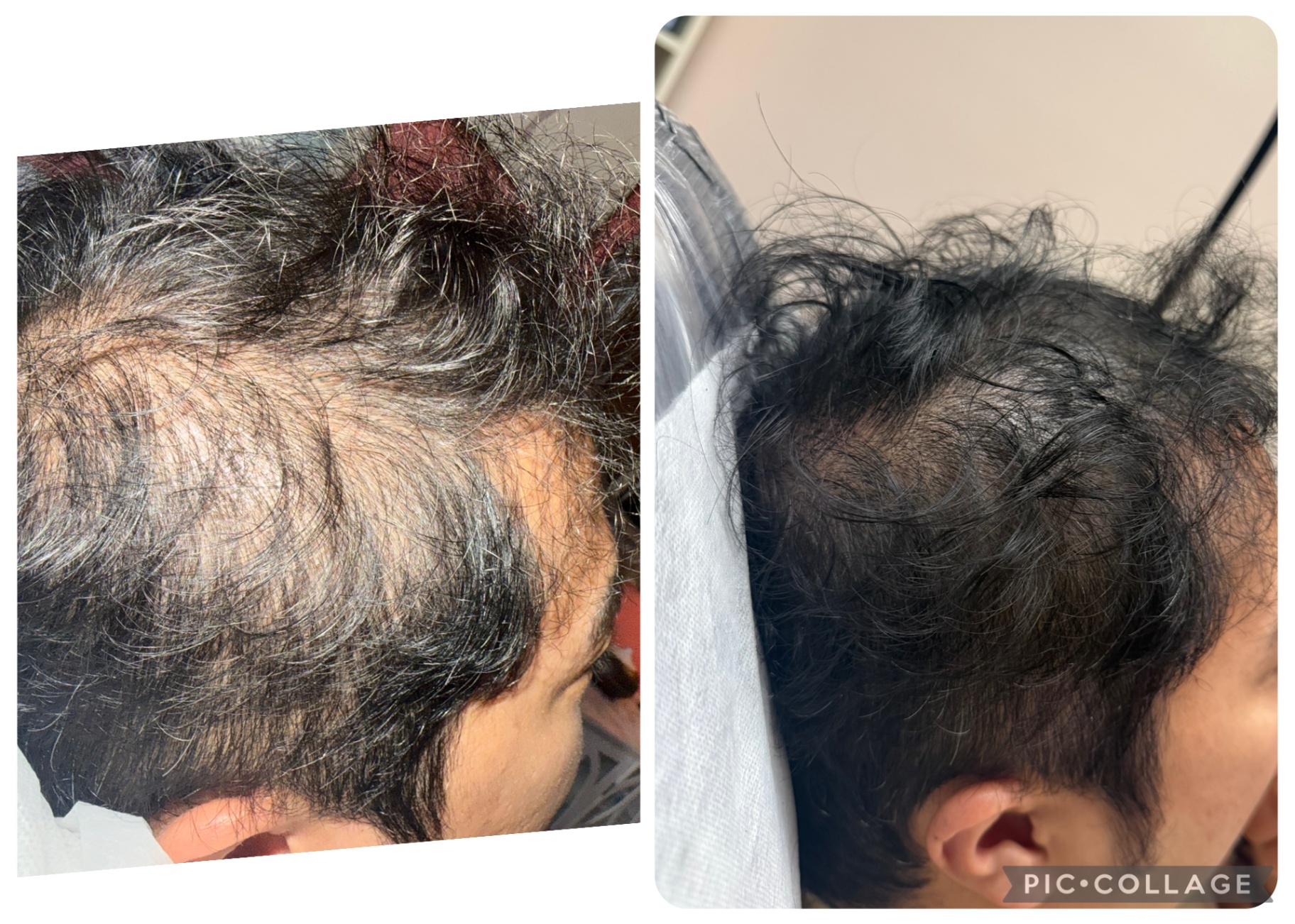 CASE 009 before and after — Men, Density, Diffuse Thinning