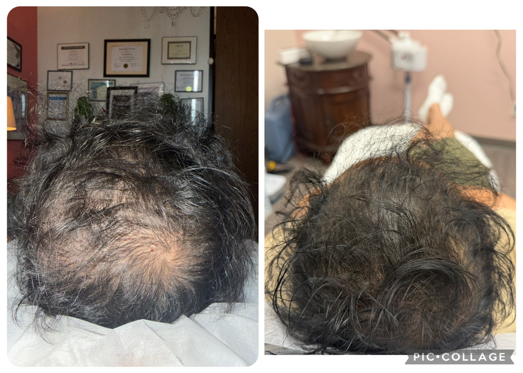 CASE 010 before and after — Men, Crown, Density, Diffuse Thinning